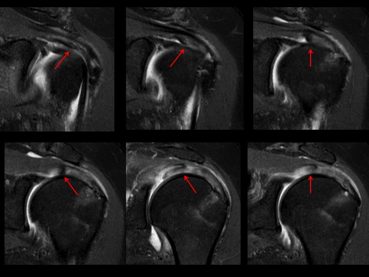 Figure 2 for case tendon of rotator cuff ( RID1948 )